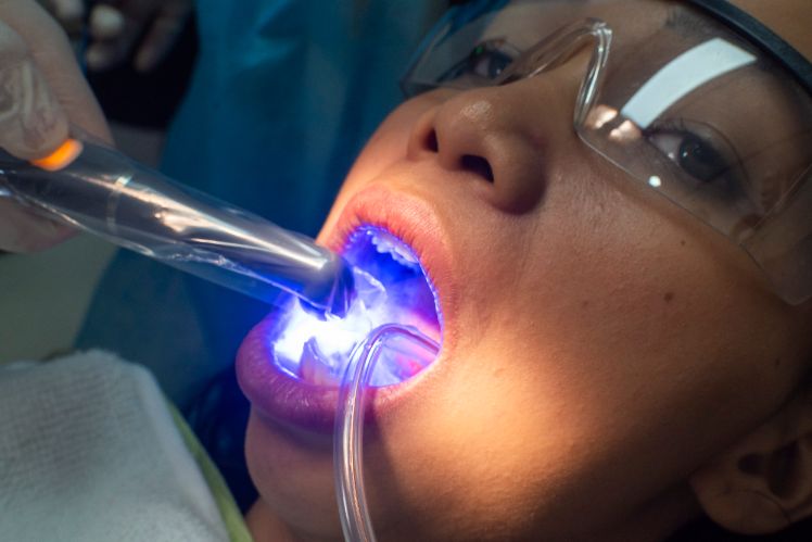 invisalign-itero-cgs-dentistry